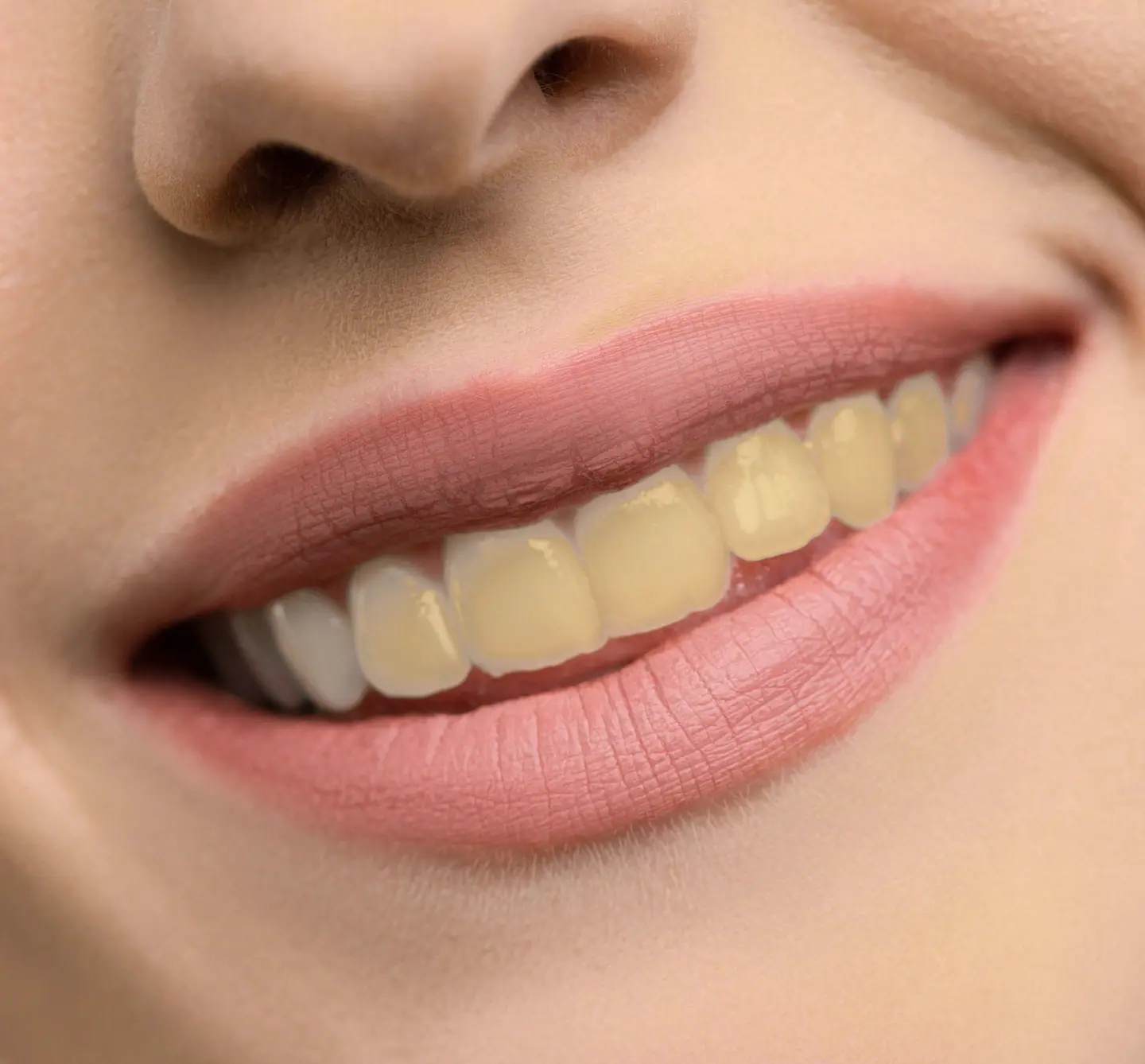Hollywood Smile için temsili öncesi ve sonrası gülüş görseli — öncesi